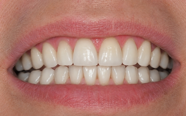 ankara diş hekimi, ankara diş kliniği, ankara estetik diş hekimliği, ankara implant, ankara implant tedavisi, ankara ortodonti, ankara şeffaf plak, ankara gülüş tasarımı, ankara zirkonyum kaplama, ankara diş beyazlatma, ankara kanal tedavisi, ankara diş eti tedavisi, ankara lamina, ankara porselen lamina, ankara diş protezi, ankara restoratif diş hekimliği, çankaya diş hekimi, çankaya diş kliniği, alacaatlı diş hekimi, yaşamkent diş hekimi, çayyolu diş hekimi