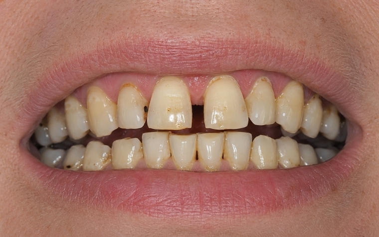 ankara diş hekimi, ankara diş kliniği, ankara estetik diş hekimliği, ankara implant, ankara implant tedavisi, ankara ortodonti, ankara şeffaf plak, ankara gülüş tasarımı, ankara zirkonyum kaplama, ankara diş beyazlatma, ankara kanal tedavisi, ankara diş eti tedavisi, ankara lamina, ankara porselen lamina, ankara diş protezi, ankara restoratif diş hekimliği, çankaya diş hekimi, çankaya diş kliniği, alacaatlı diş hekimi, yaşamkent diş hekimi, çayyolu diş hekimi